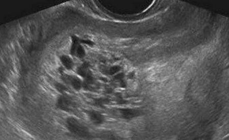 医生|怀孕女子嫌产检麻烦,5个月后才到医院,结果肚子里全是小蝌蚪