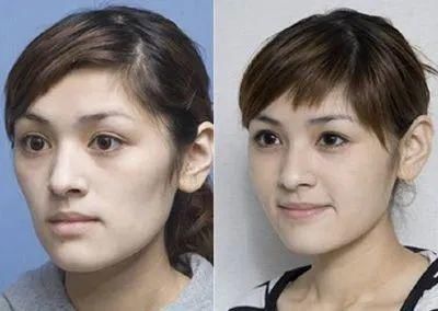 面部凹陷太显老，想要变回少女脸，你得这样做！