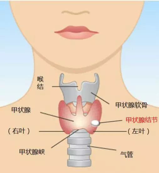 甲状腺|甲状腺结节是“吃”出来的？