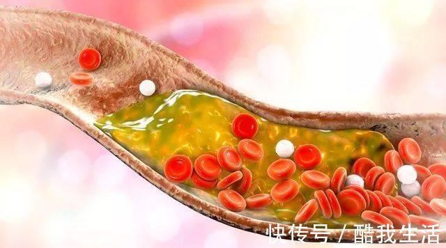 升高|素菜也会升高血脂？提醒：血脂偏高的人，这几种素菜建议少吃