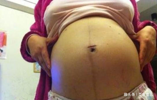 小知识|孕妈怀上双胞胎,全家兴高采烈,检查后医生却说那不是孩子!