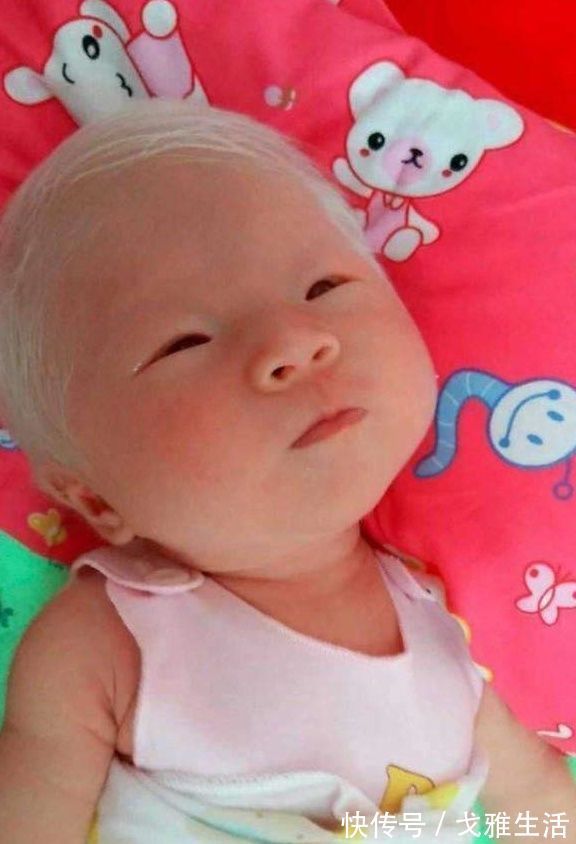 白化病|孕妇产下孩子一头白发,医生却说没什么!
