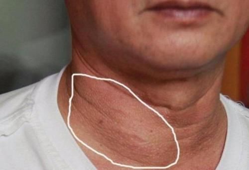 甲状腺结节患者|甲状腺结节能吃葡萄吗？提醒：这四类食物，再馋也不要多吃