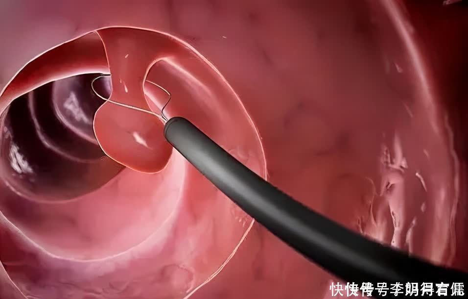 息肉|做结肠镜检查真的很可怕吗?专家说完后,相信你不会再觉得尴尬了