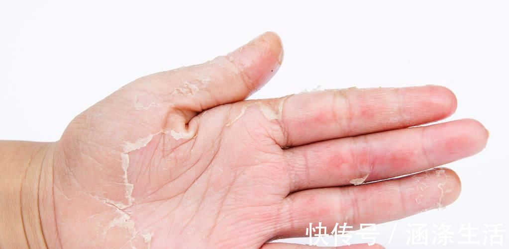 淀粉酶|湿疹太顽固家里小小的‘它’,让你一周彻底根治,皮肤焕发生机
