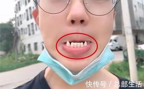 牙科医生|15岁男孩长出“尖牙”,妈妈亲手摸过后吐槽:养了个“吸血鬼”