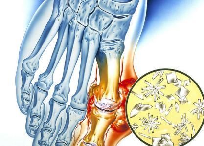 痛风|45岁男子一检查就发现痛风,是怎么回事?原来是因为此生活习惯