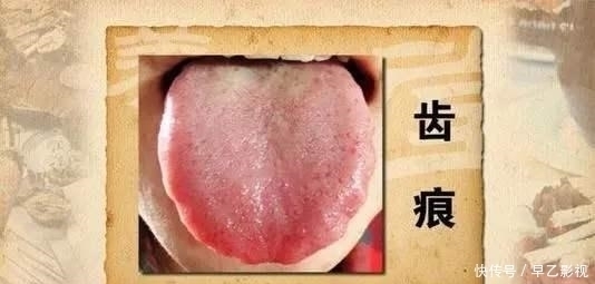 肝臟|肝內有疾，牙知道！當牙齒出現3個異常，可能是肝病在敲門