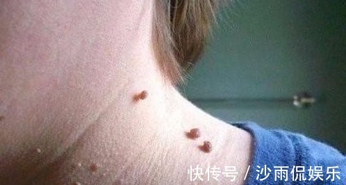 野草|农村有种常见的野草,是治疗瘊子的良药,分分钟治好,不再长