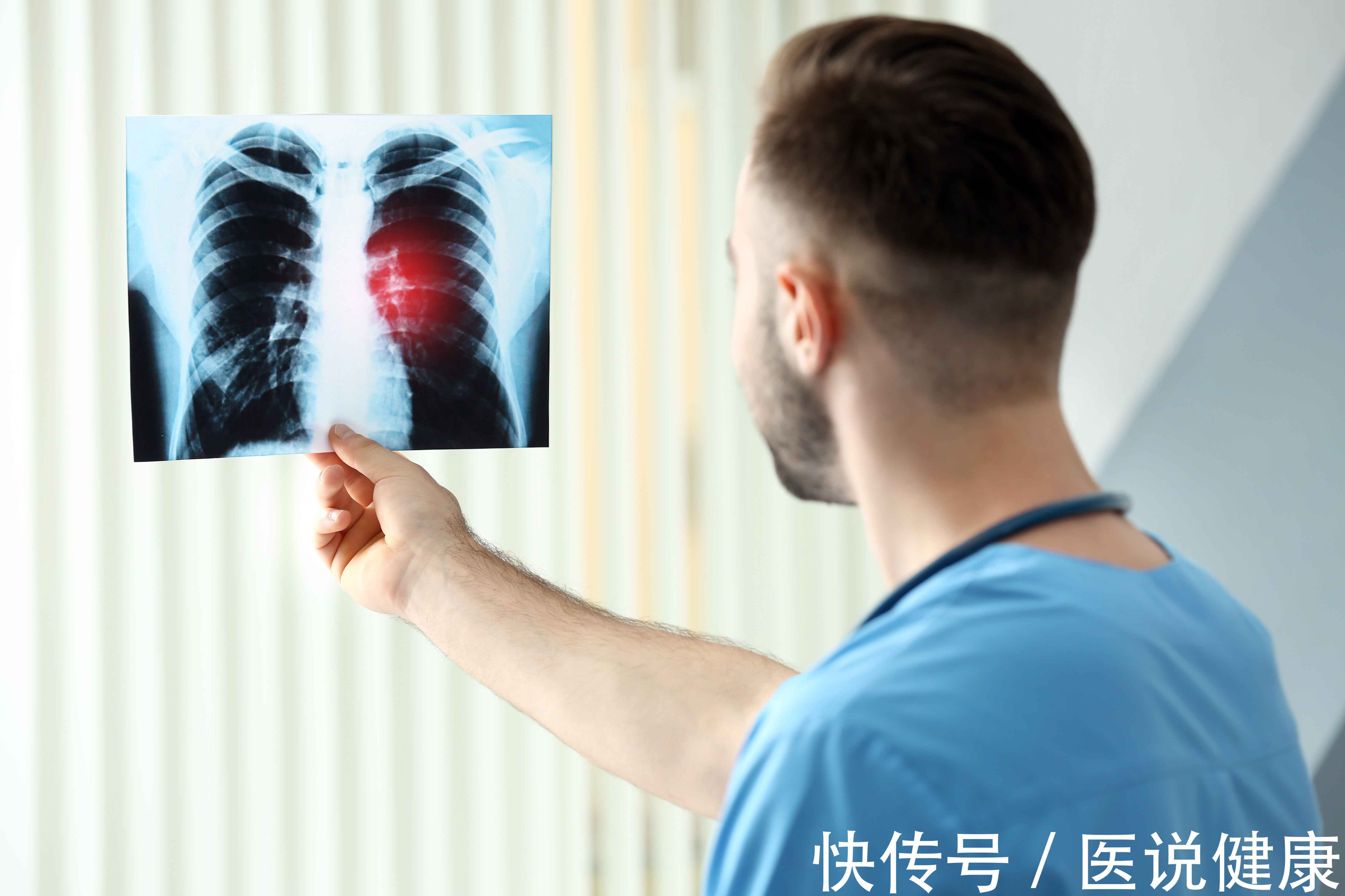 气体|肺癌是如何发生的？这4个高危因素，或是肺癌主要原因，尽量避开