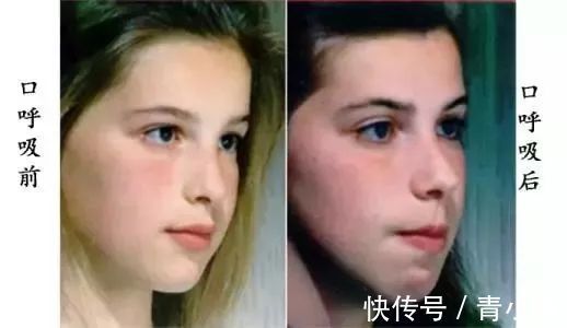 不良习惯|这样的睡姿你家宝贝是否也有呢？其实这都是口呼吸惹的祸！