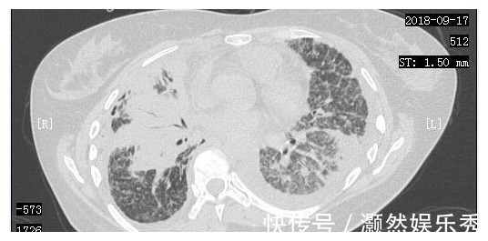 癌细胞|23岁女孩癌细胞全身扩散，一年抗癌出奇迹