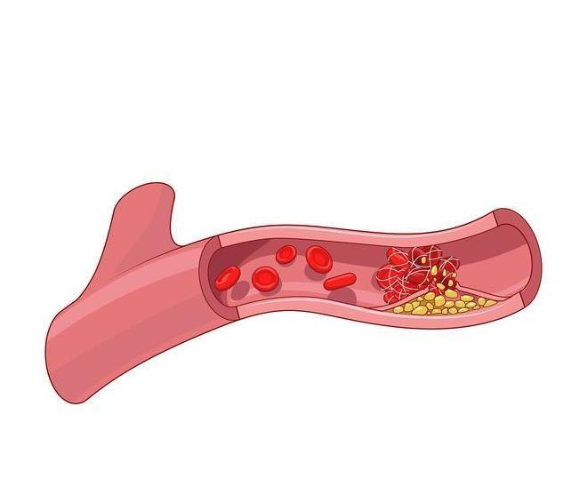 升高|血脂怎么动不动就升高？什么食物建议要远离？