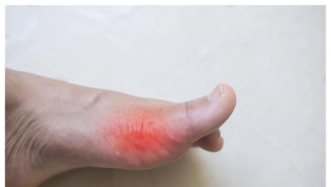 饮食习惯|尿酸升高痛风“来袭”，养成这4种饮食习惯，与痛风说“再见”