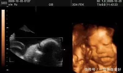 彩色|普通B超、彩超和三维、四维彩超有什么区别,孕妈带你图解!