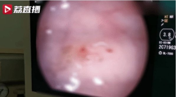 医院|17岁少女腹痛难忍，去医院一看肠道内布满寄生虫，还活蹦乱跳的！