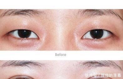 眼睛|做过双眼皮手术的年轻人,老了以后眼睛会怎么样看来是这个道理!