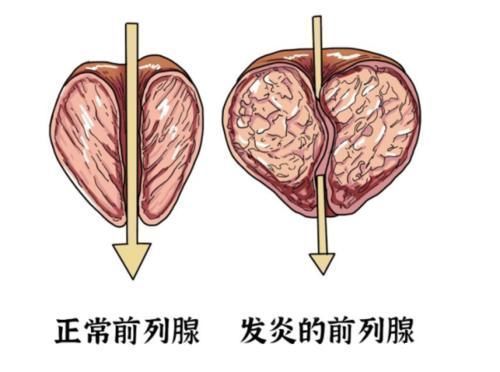 分泌物|男人的“绿色黄金”发现了,不是韭菜,家里常备,前列腺疾病靠边站!