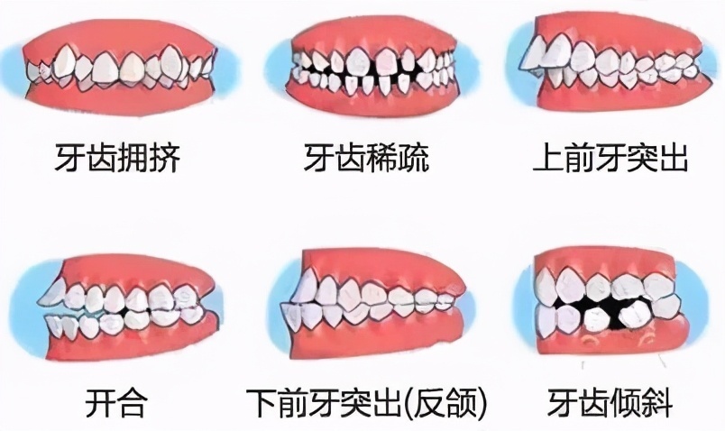 矫正|儿童牙齿正畸什么时候做合适？