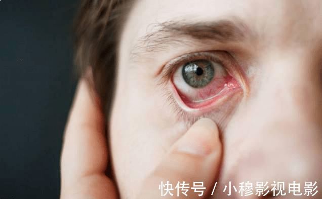 肝病|晨起若有4种“异常”,肝或已“烂如蜂窝”,一个不占,肝还“轻松”