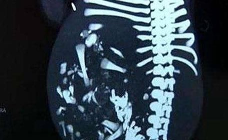 肥胖症|五岁女儿肚子巨大,以为得了肥胖症,检查结果家人难以接受