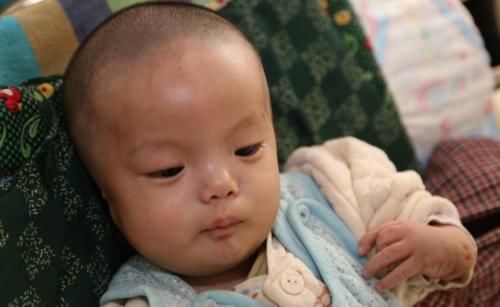 mri|如何第一时间发现脑瘫，脑瘫的4个异常