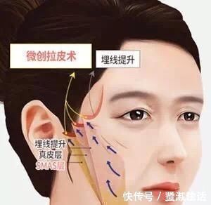 微创 聊一聊除了拉皮手术,微创小切口提升怎么样?多大年纪适合做?