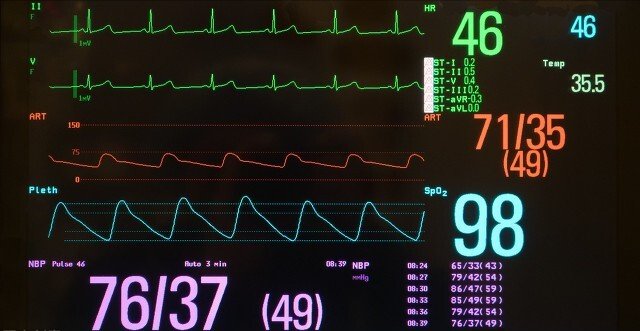 头晕乏|经常头晕乏力、气促胸闷，心率＜60，谨防严重心动过缓，可这样治