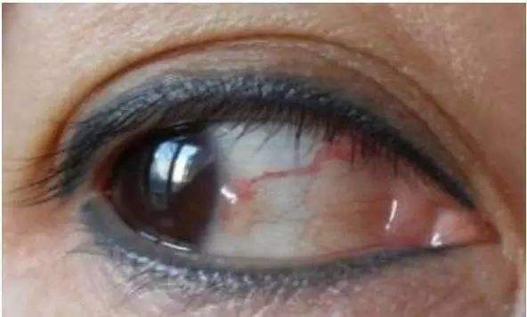 五脏|体内有癌，眼睛先知！异常出现在眼白上半部