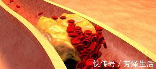 血管|眼睛出现3情况，血脂已经挤满血管，常用2方法，清掉多余血脂