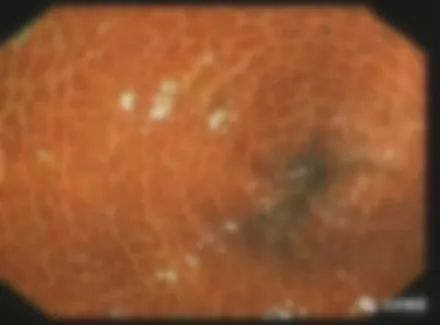 便秘|热搜第一！一女子的检查报告吓坏网友