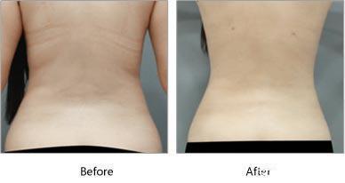 卵巢早衰|“减肥六个月后，我失去了生育能力”