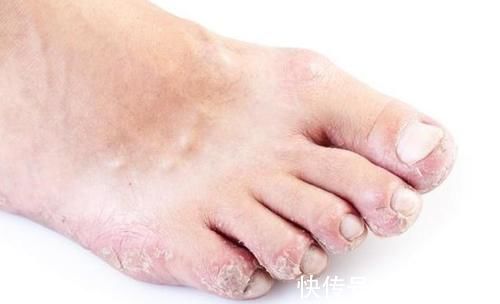 升高|3种调料,正在“偷偷”升高你的血糖,劝告父母,能不放就不放