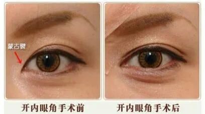 听说10个开内眼角，9个留疤？眼角还敢开吗？