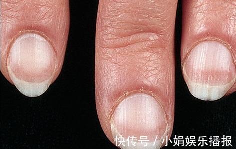 黄甲综合征|身体有问题,指甲告诉你!指甲出现9种变化,恐是疾病来袭