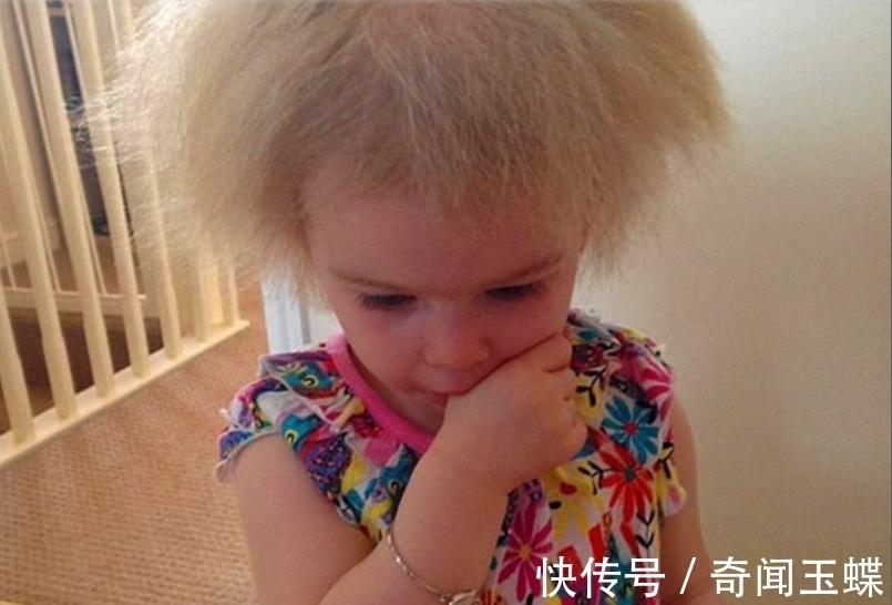 梳头|世界上最奇怪的病,患者不能梳头,全球仅有百例,爱因斯坦是其一