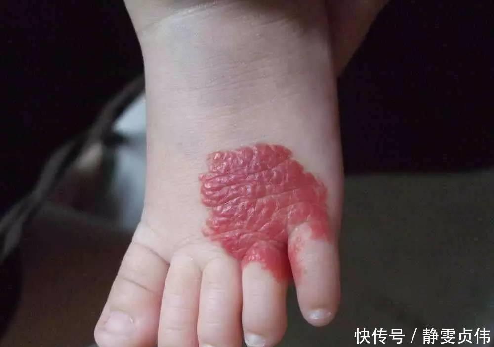 先天性|那个脸上有“蝙蝠”胎记的女孩,如今生活的怎么样?看完很欣慰