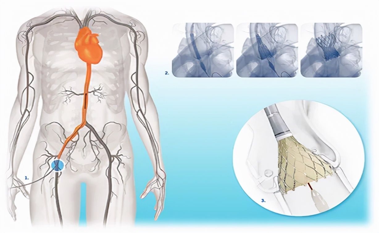 起搏器|“心门”坏了、冠脉堵塞、心脏乱跳,一根导管解决诸多心脏顽疾