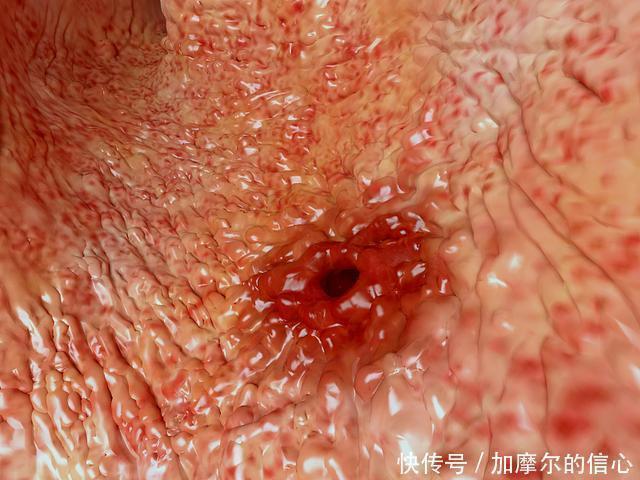 胃穿孔|3种水果''伤胃不浅''，你若常吃，胃将''烂''得更快，劝趁早戒掉