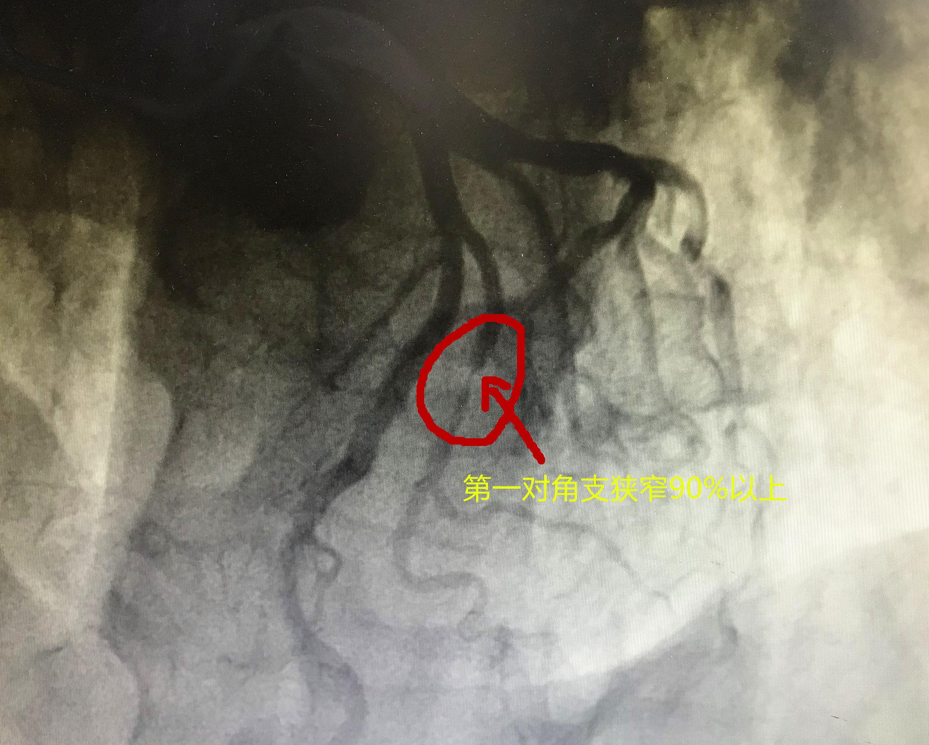 77岁老人反复心绞痛,吃饭的时候都发作,支架治疗后,结果怎样了