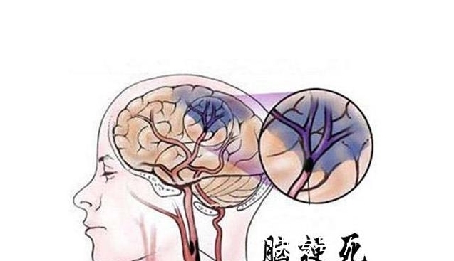 常吃|62岁阿姨突发脑梗，医生：此物吃一次等于8斤肥肉，常吃自毁血管