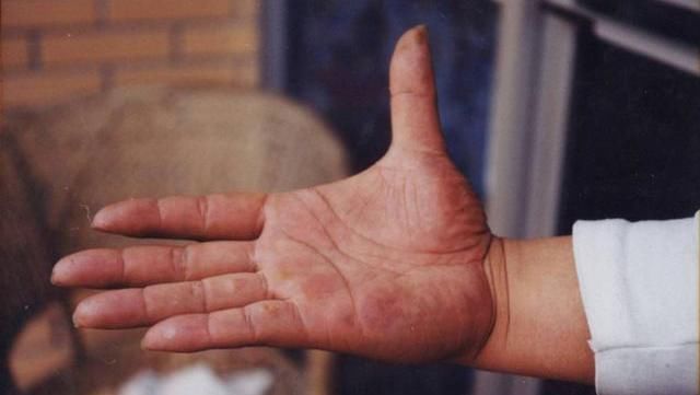 不小心烫伤了怎么办?千万不要自行乱涂牙膏等东西