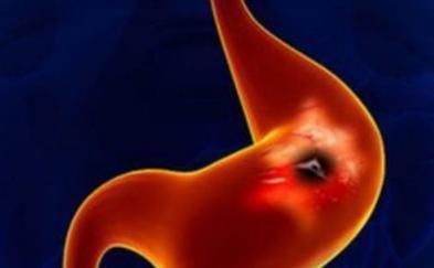 身体|当你的身体发出以下4个“信号”时,有可能胃癌找上门来了!