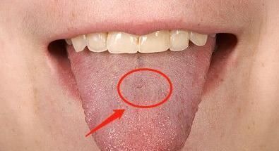 胃中感染幽门螺旋杆菌,身体多有3大变化,若一个不占,值得高兴