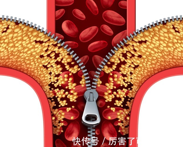 降血脂|头部3个异常，血脂已黏如粥，医生：做好2多3少，降血脂