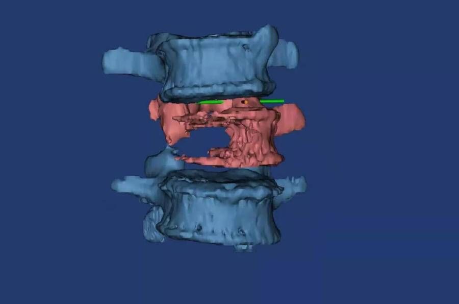椎体|烟台山医院成功完成全脊柱肿瘤切除＋3D打印人工椎体置换术