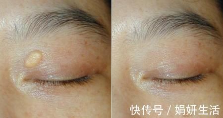 脂质|身体出现这些表现, 是血脂变高的信号, 你有吗