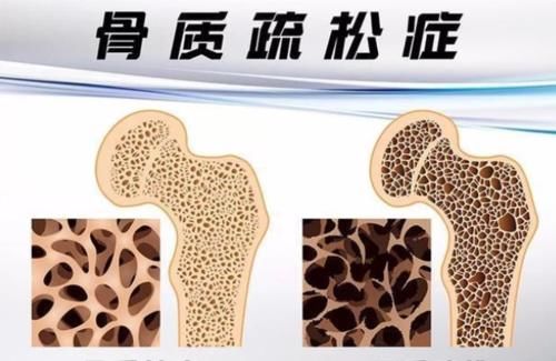 元素|燕麦与骨质疏松症有什么关系?保护好骨骼,尽量少吃这几种食物