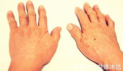 神经末梢|夜间经常手麻，是颈椎病 医生提醒：1种病的可能性更大，勿忽视