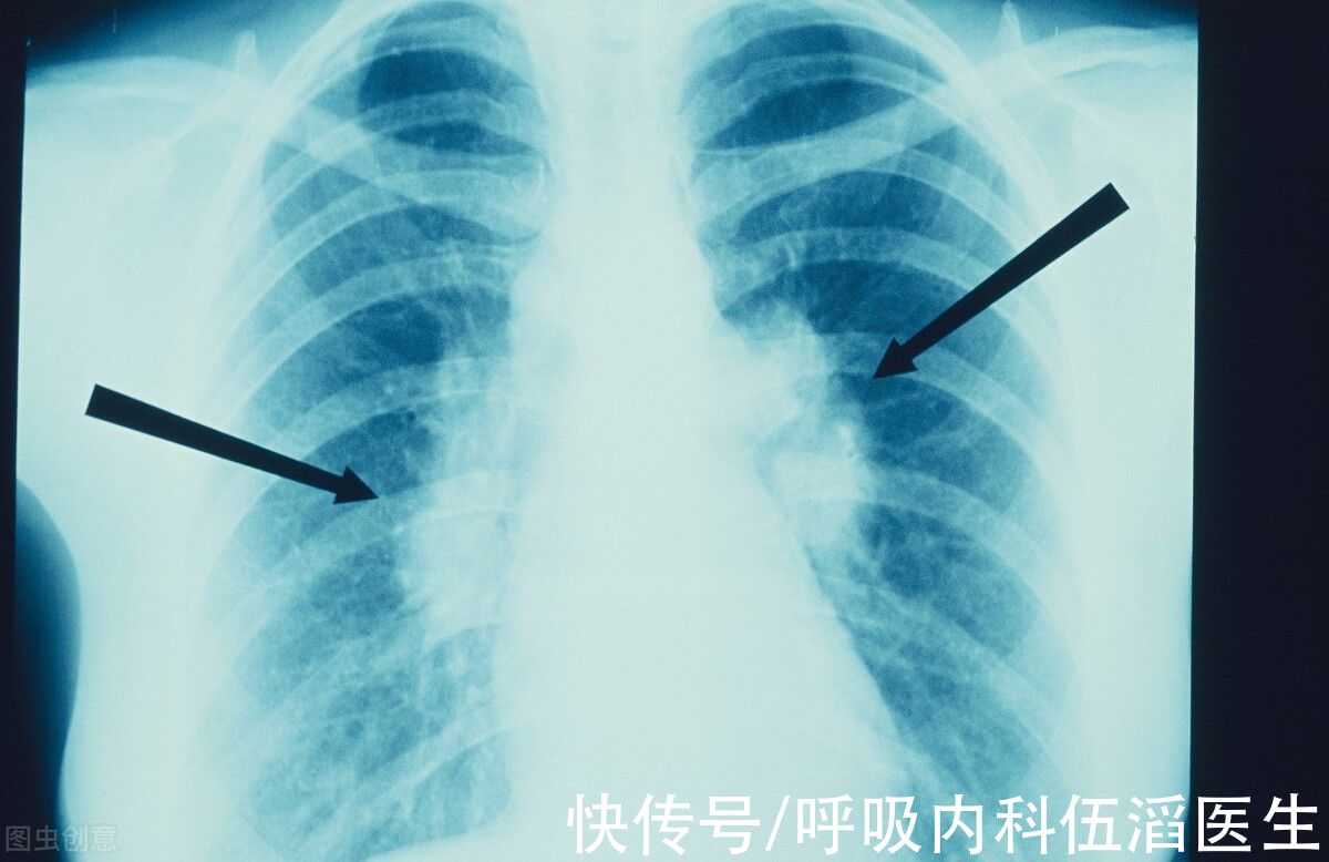 癌症|医生提醒：体内有肺癌，皮肤多会出现2种现象，劝你别忽视